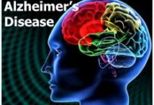 alzheimers